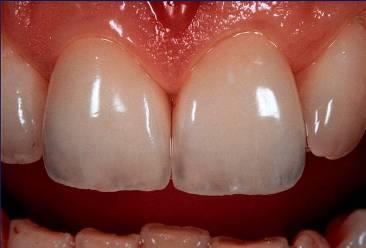 DIE OPTISCHEN EIGENSCHAFTEN DER ZÄHNE Die Zähnarbe ist weißlich-gelblich oder
