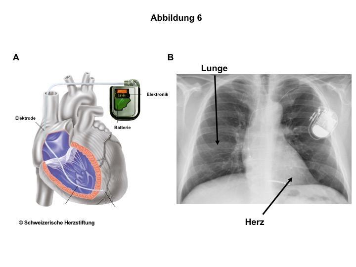 Abbildung 6 A. Interner Defibrillator (ICD). B.