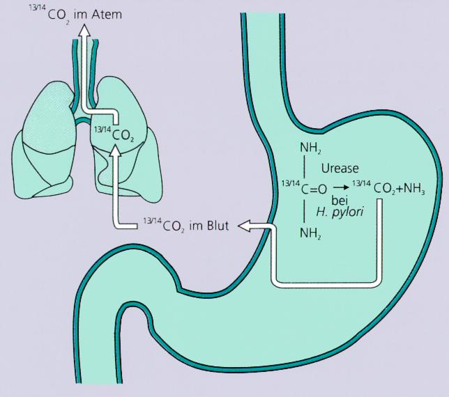 Peptisches Ulcus Helocobacter pylori Diagnostik: 13-C-Harnstoff-Atemtest