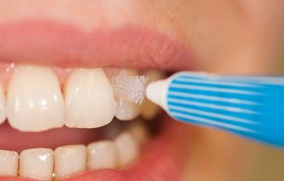 Zahnbürsten können nur die Kau- und Seitenflächen der Zähne reinigen. Die Zahnzwischenräume werden von ihnen nicht erreicht.