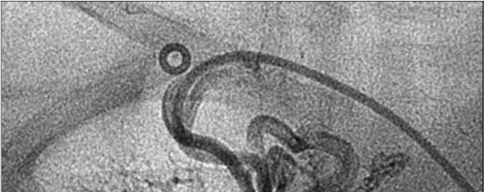 Patienten und Methoden wurde in dargestellt einer und selektiven die Lage 13 Angiographie der Implantate Verschluss von Kollateralgefäßen Anzahl aorto-pulmonaler Kollateralen (n) Ursprung und Verlauf