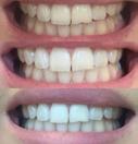 AP24 Whitening ZAHNPASTA AP-24 WHITENING ZAHNPASTA Für saubere, natürlich weiße, gesunde Zähne - wirkt der Neubildung von Plaque entgegen.
