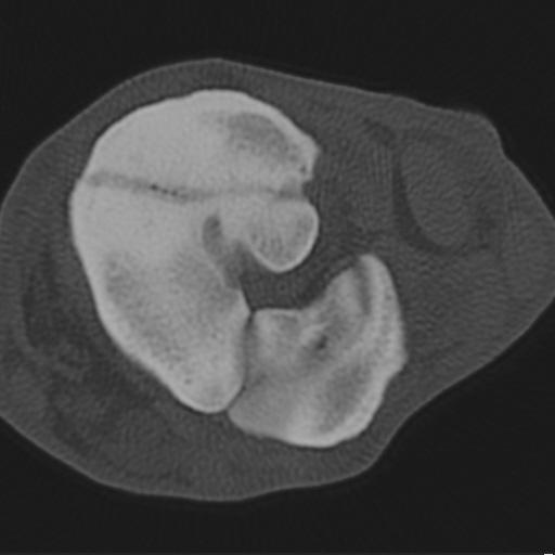Abb. 6c (Fall 10): Computertomografischer Transversalschnitt durch den linken Tarsus eines 13-jährigen