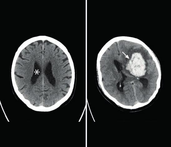 Computertomographie (CT) 451 CT-Untersuchungen mit Darstellung der Hirngefäße werden CT-Angiographie bzw. CT-Venographie genannt.