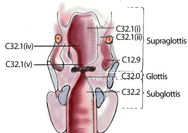 Larynx Bezirke Supraglottis Epiglottis Aryepiglottische Falte Aryknorpel Taschenfalten Glottis Stimmlippen vordere/hintere Komissur Subglottis T-Kategorie Supraglottis T1 auf Supraglottis begrenzt,