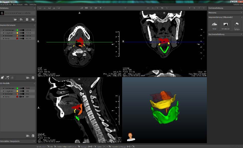 Prozesskette von der OP-Visitation zum Prototyp Auswahl einer Standard- Geometrie des Kopf-Hals- Bereiches Auswahl