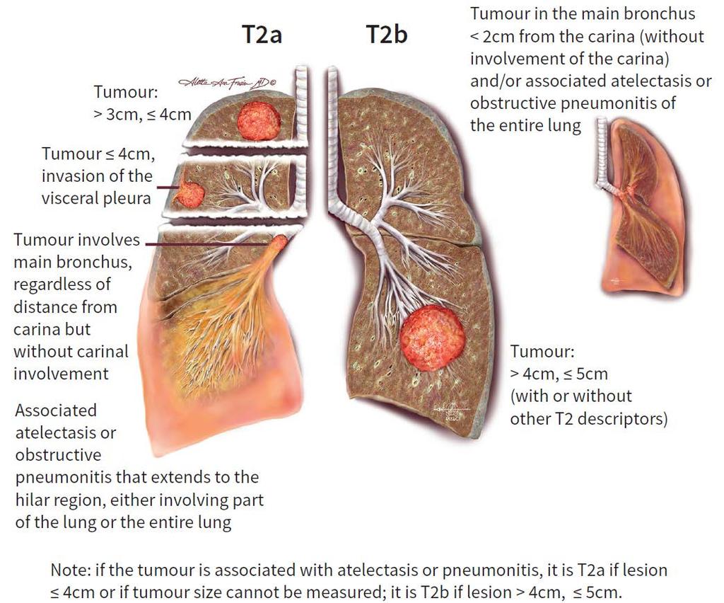 15 IASLC, 8th TNM staging manual