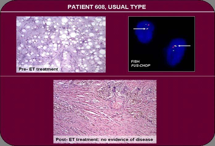 Complete Pathological Response Pre-treatment: myxoid liposarcoma. FISH positive for FUS-CHOP.