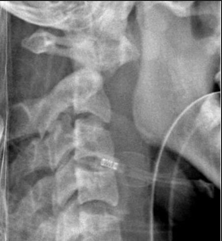 Atlanto-dentale Instabilität bei RA > Langjährige RA (selten Spondylarthritiden) > Leitsymptome: > Nackenschmerzen, Parästhesien