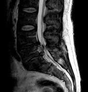 etc.) Radiculopathie bedingt durch Bedrängung eines Rückenmarksnerven (Schmerzausstrahlung - Ischiasschmerz, umschriebene Schwäche und/oder Sensibilitätsstörung in den Beinen) Polyradiculopathie