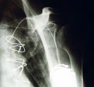 Die Omo Neurexa plus besteht aus zwei Teilen einer Schultermanschette und einer Unterarm manschette. Beide Manschetten sind durch zwei Gurte miteinander verbunden.
