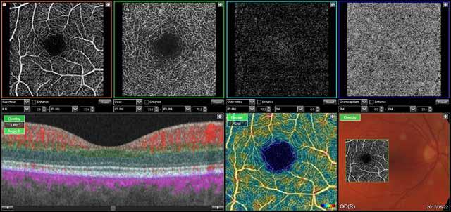 Genaues Tracking System Superficial Deep Outer retina Choriocapillaris Auf die OCT-Scanline einrasten OCT-Scan Das SMARTTrack, welches im DRI OCT Triton