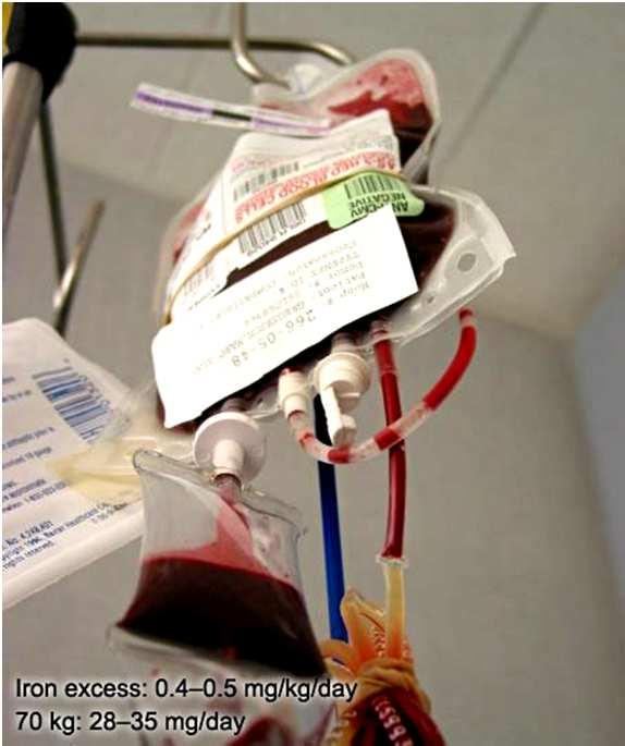 EK-Transfusion ist Fe-Transfusion Grobe Berechnung 1 EK enthält ~200 mg Eisen 0.47 mg Fe/mL Vollblut 1.