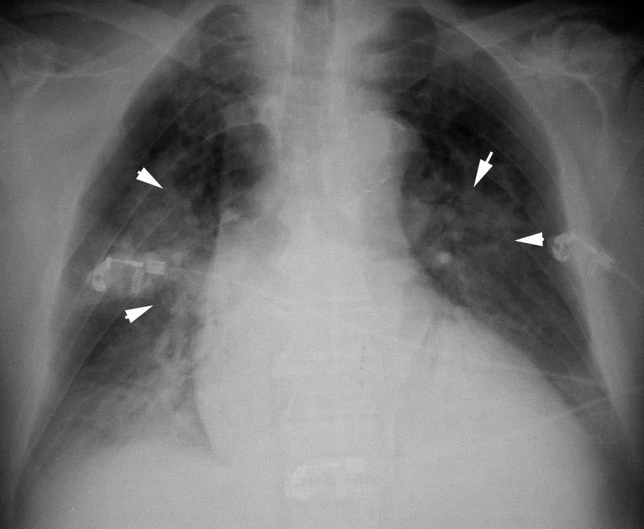 perihiläre Lymphspalten (cuffing) Stauung Grad 3 (pvp >25) Alveoläres