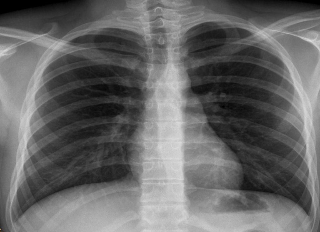 Was sehen wir im Röntgenbild? Grenze Luft/H2O (Weichteile) Anatomische Grenzen z.bsp.