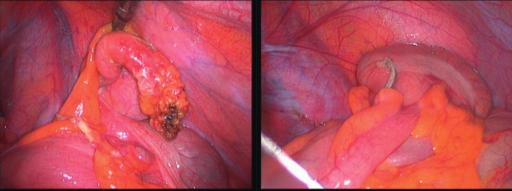Notfallmedizin 22/1/2013 Abb. 4. Bild einer akuten Appendizitis vor und nach erfolgter Stapler-Resektion version zur Laparotomie vermeiden zu können.