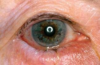 Entropium: Genau umgekehrt verhält es sich beim Entropium: Das Unterlid dreht sich nach innen und die Wimpern reiben ständig am Auge.