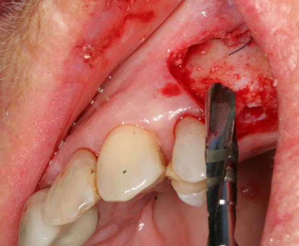 Vorgehensweise Gegen Jahresende 2011 erfolgen die chirurgische Parodontalbehandlung im Ober- und Unterkiefer sowie die Extraktion der Zähne