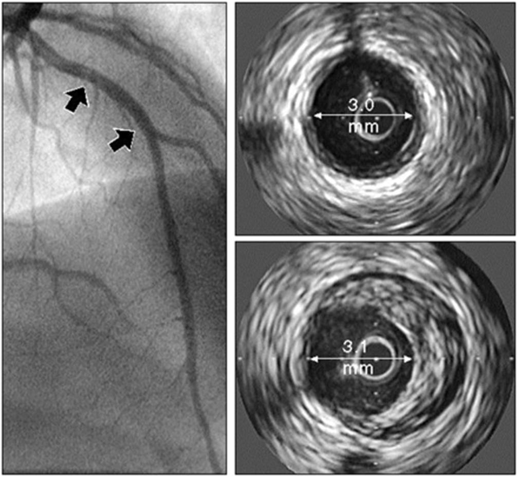 The IVUS technique can detect angiographically silent atheroma Angiogram No evidence of disease Little