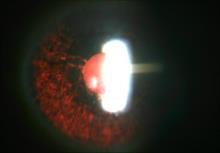 Jahr bei Systemerkrankung der Sarkoidosepatienten: Augenbeteiligung Erstmanifestation einer Sarkoidose am Auge Ein Auge