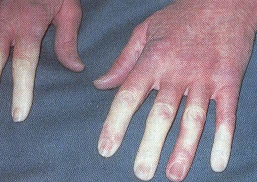 Finger - Sklerodermie - proximale Myalgien/ Muskelschwäche Raynaud-Syndrom