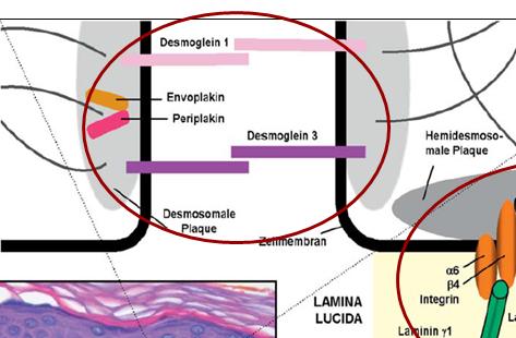 1. Pemphigus-Erkrankungen Symptom: Adhäsionsverslust zwischen Keratinozyten durch Funktionsverlust der Desmosomen intraepidermale