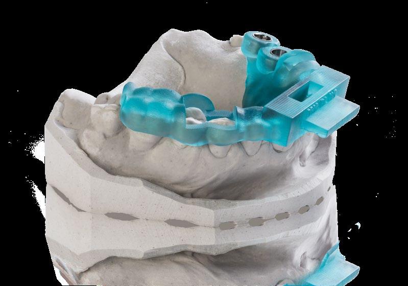 SMART WÄHLEN VarseoWax Surgical Guide Das Harz für den 3D-Druck von Bohrschablonen und Implantatprothetik-Einsetzhilfen VarseoWax Surgical Guide ist ein chemisch