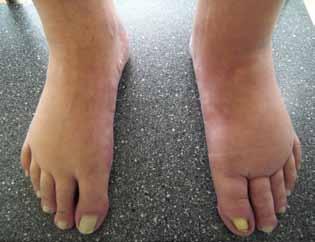 Abb. 3: Lymphödem links mit Einbeziehung von Fußrücken und Zehen. Falsche Strumpfversorgung mit offenem Strumpf (siehe Abdruck Fußrücken).