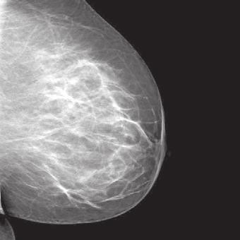Mammographie Hohe Aufl ösung sichere Diagnostik Bei der Röntgenuntersuchung der