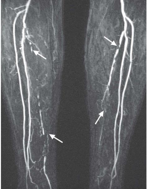 2. Periphere arterielle Verschlusskrankheit (pavk) Abb.: MR-Angiografie: Befund bei pavk. Die Unterschenkelarterien sind mittels Kontrastmittel hell dargestellt.