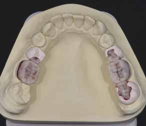 TECHNIK dd Abb. 80 und 81 Schließlich werden die Zahnformen komplettiert, die approximalen Kontaktpunkte angelegt und die Ränder kontrolliert 80 81 Abb.