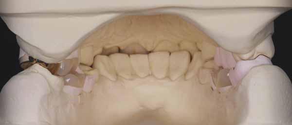 Für Zahn 15 ist okklusaldistal ein Inlay und für Zahn 16 ein MOD- Inlay vorgesehen 106 Abb.