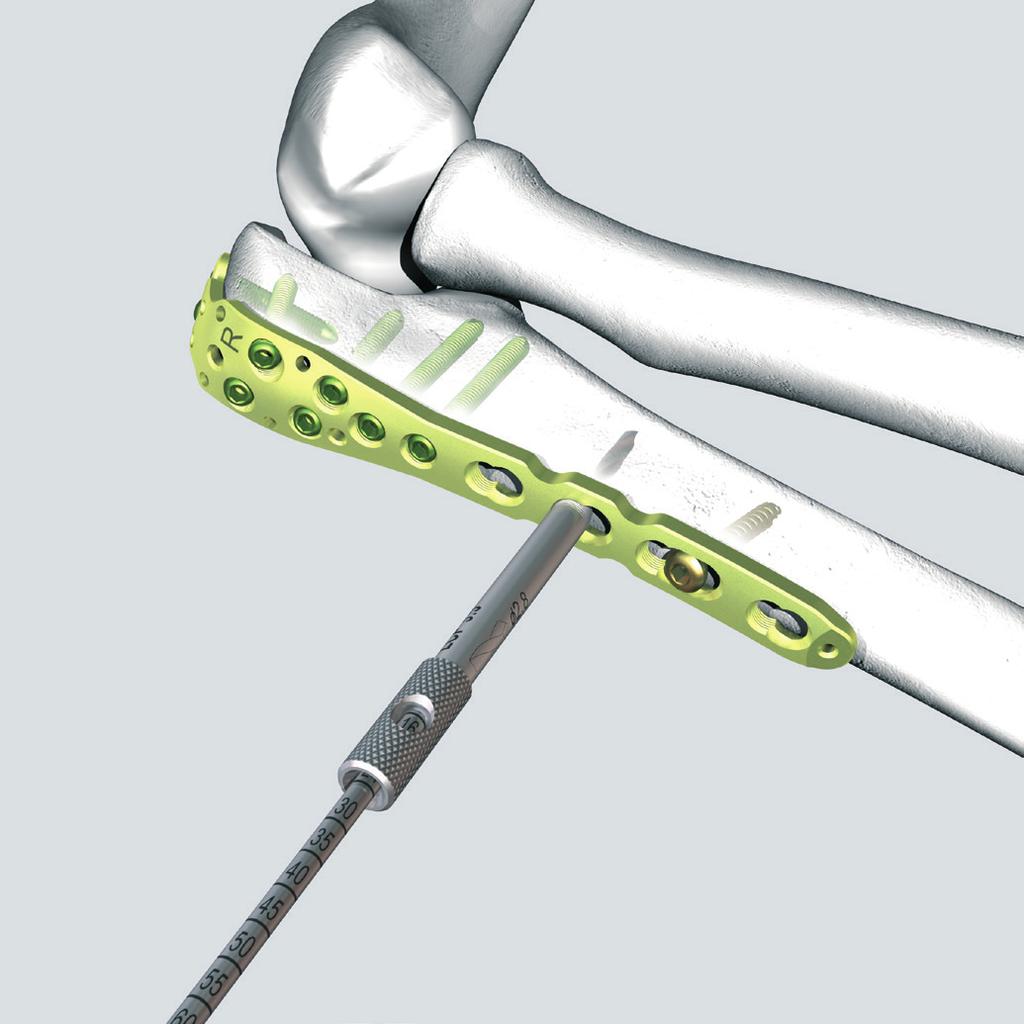 Implantation 8 Schrauben in den Schaft einbringen Benötigte Instrumente 323.027 LCP-Bohrbüchse 3.5, für Spiralbohrer Ø 2.8 mm 310.284 Spiralbohrer Ø 2.