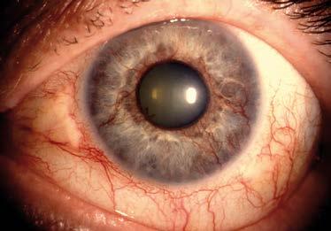 Augeninnendruckerhöhung Rubeosis iridis, Kammerwinkel verschlossen, konjunktivale und ziliare Gefäßinjektion, Vorderkammerreizzustand, ggf. Hyphäma, Augenschmerzen?