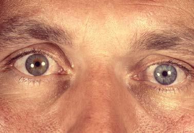 Augeninnendruckerhöhung Hornhautödem, Linse nach vorn subluxiert, Vorderkammer vollständig oder partiell aufgehoben Ziliolentikulärer Block Hornhautödem, flache oder aufgehobene Vorderkammer,