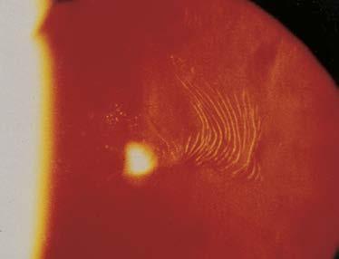 Basalmembran-Hornhautdystrophie (Map-Dot-Fingerprint-Hornhautdystrophie) Abbildung 217: Wie ein Fingerabdruck (fingerprint) aussehende Trübungslinien im