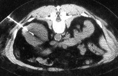 Nierenbiopsie CT Scan zeigt