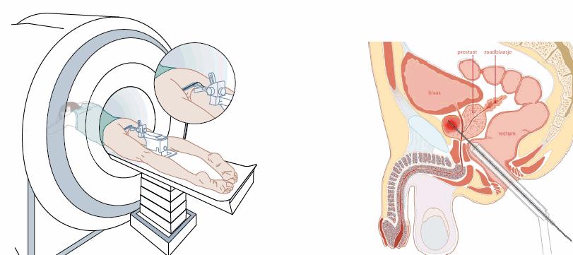 Die MRI gezielte Prostatabiopsie Technik: Transrektale Biopsie in Bauchlage unter Nadellage-Kontrolle mittels MRI