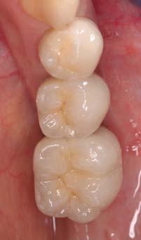 Vor dem Hintergrund dieser Ergebnisse ist die Verwendung konfektionierter Abutments im Seitenzahnbereich kritisch zu hinterfragen, da sowohl metallkeramische als auch vollkeramische Versorgungen