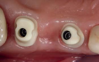 ANKYLOS-Implantaten (DENTSPLY Implants, Mannheim). Der interimplantäre Abstand entspricht nicht der Position der zu ersetzenden Zähne. Abb.