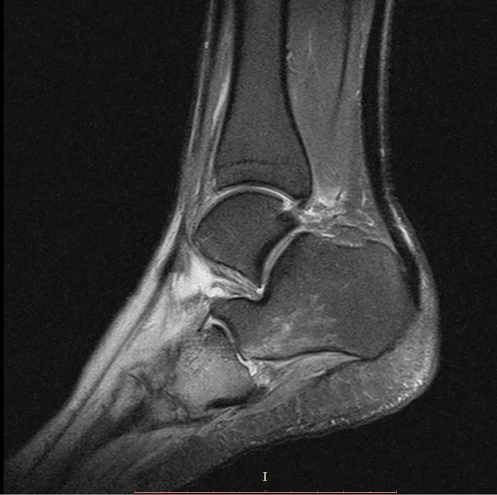 Fallbeispiel Charcot-Versorgung 2.