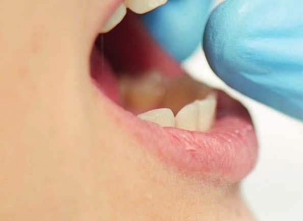 2 Starker Halt an der Zahnhartsubstanz - Die Haftfestigkeit auf Dentin wurde noch einmal erheblich