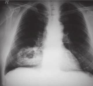 10: Asbestose: retikuläre Zeichnungsvermehrung der Unterfelder beidseits, rechts Adenokarzinom der Lunge mit zentraler Nekrose Abb. 11: Asbestose Abb.