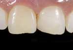 Zähnen Facettenreparaturen Restauration von Milchzähnen Kronenstumpfaufbauten Composite-Inlays Zahnähnliches für zuverlässige Restaurationen Sehr hoher Füllstoffgehalt von 89