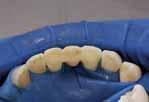 Ersatz des fehlenden Zahnes unter Verwendung eines Kunststoffzahnes Für die temporäre oder semipermanente Versorgung einer Zahn lücke unter