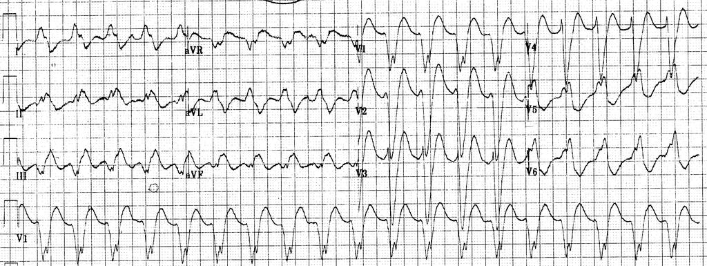 B) Breitkomplextachycardie, rhythmisch Die differentialdiagnostischen Kriterien der rhythmischen Breitkomplextachycardie zur Unterscheidung zwischen ventrikulärer und supraventrikulärer Tachycardie