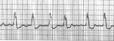 Klinik, Therapie: 1. klinisch instabil: a) EKG-Dokumentation so vollständig wie möglich (wenn möglich immer 12- Ableitungs-EKG). b) Kardiovertieren d.h. mit synchronisiertem Defi unter Sedierung!