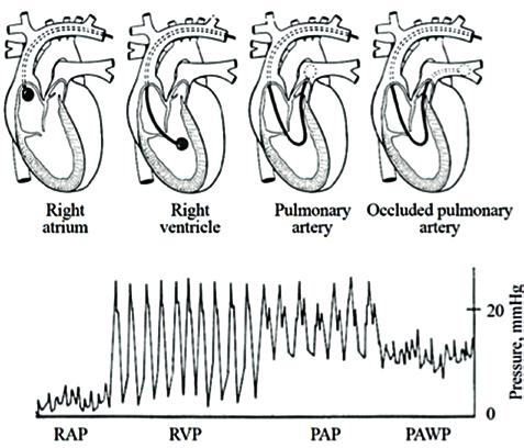 rechten Ventrikel deutet auf einen atrialen Links-rechts-Shunt, eine Differenz >5% zwischen dem rechten Atrium und der Pulmonalarterie auf einen ventrikulären Links-rechts-Shunt hin (22).