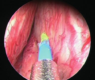 Hierfür wird ein Instrument über die Harnröhre (transurethral) eingeführt, das Prostatagewebe unter Sicht abgetragen und entfernt. Anschließend wird das Gewebe histologisch untersucht.