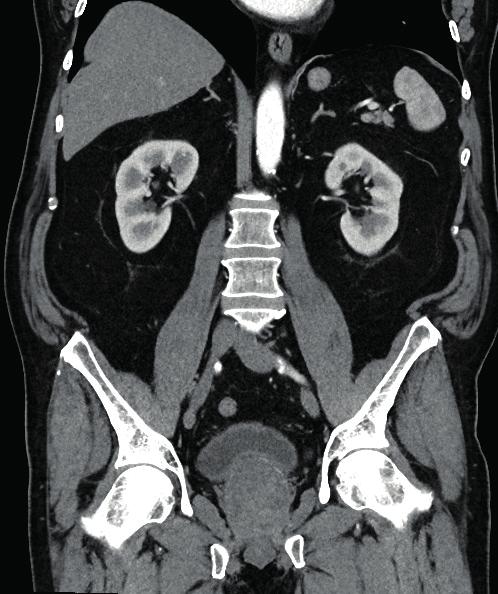 Minimalinvasive Prostataretraktoren Urolift Prostata - Arterienembolisation (PAE) Beim UroLift -System wird durch das Einbringen von mechanischen Haltestrukturen ein Zusammenpressen der